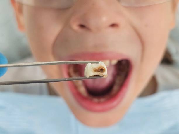 Best Dental Abscess Treatment in Marietta, OK